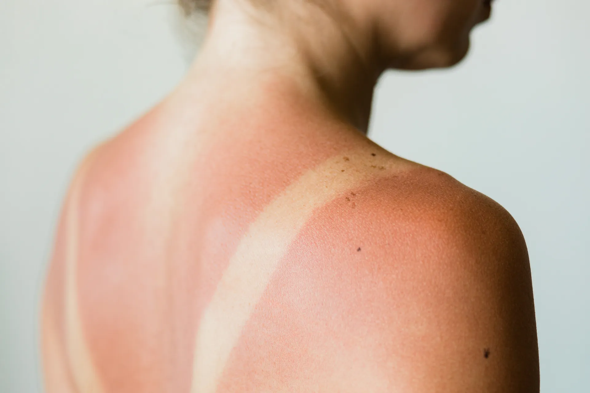 lady with sunburn
